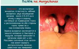 Как выглядит ангина у ребенка – Болезниус – болезни, их описание, лекарства и способы лечения