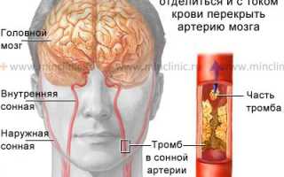 Тромб в голове: симптомы, лечение, последствия тромбоза сосудов головного мозга